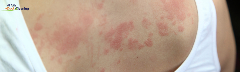 Allergic Reaction on backside